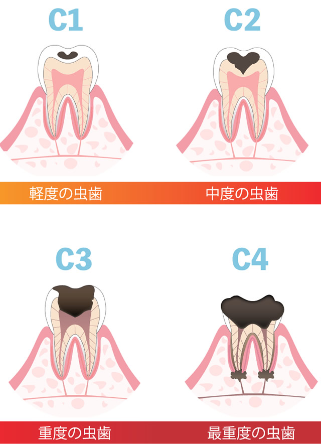 むし歯