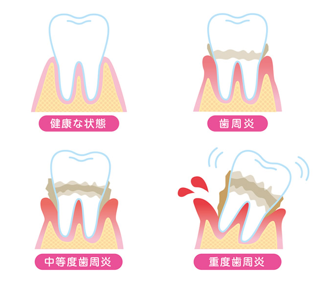 歯周病