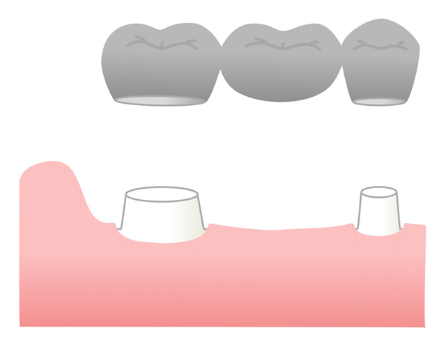 入れ歯・ブリッジ